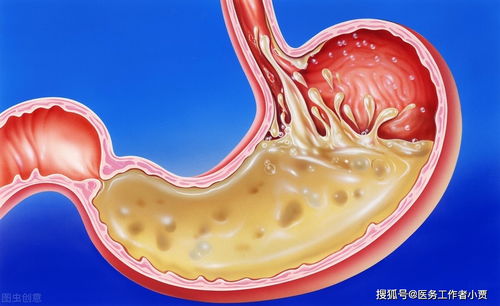 梅核气的症状有哪些(梅核气的症状有哪些吃什么药治疗效果好) 20240520更新